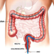 colonoscopia-1