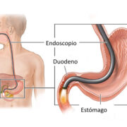 endoscopia-digestiva-superior