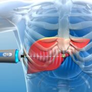 Fibroscan-o-elastografia-hepatica