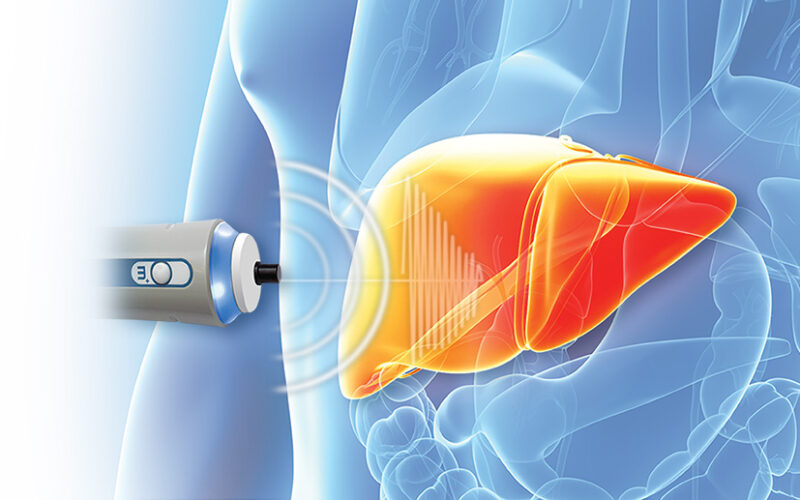 Fibroscan_Image_3 Fibroscan_Image_3
